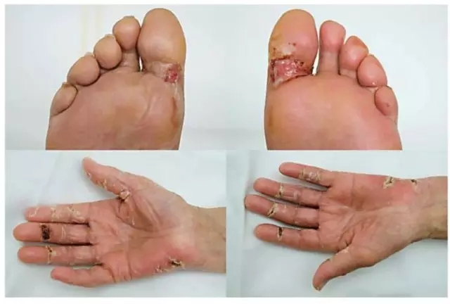 肿瘤不良反应怎么治疗最好,放个大招完整版教学