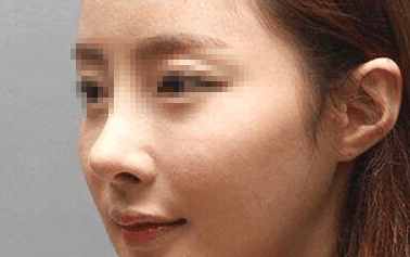 有多少人隆鼻后悔了,隆鼻的十大猫腻