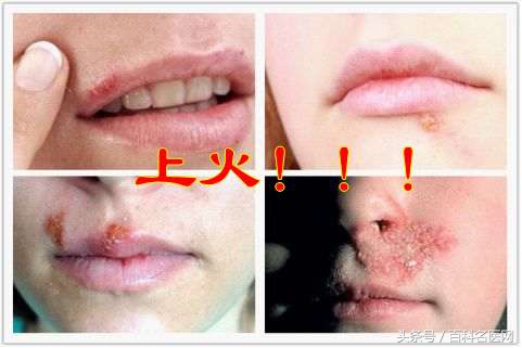 喉咙痛嘴角起泡吃什么药,上火喉咙疼嘴上起泡用什么中药