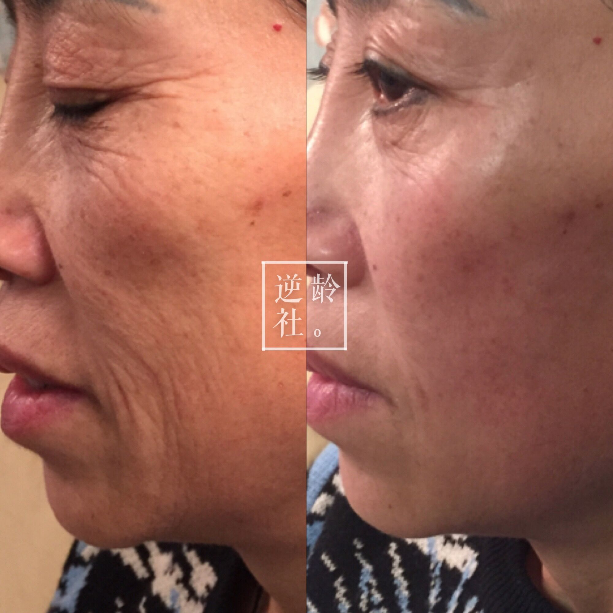 逆龄精雕好还是超声刀好,35岁做超声刀效果好吗