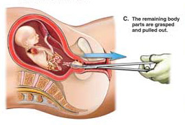 人流手术中胎儿是怎么被取出来的？看了这几张图片你还狠得下心吗
