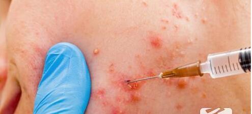 祛除痘印痘坑最好的方法,天然维生素e祛除痘印有效果吗