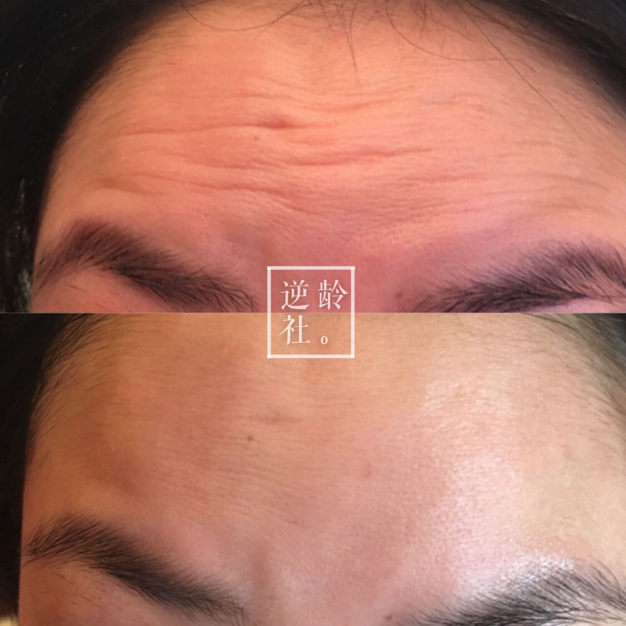 逆龄精雕好还是超声刀好,35岁做超声刀效果好吗