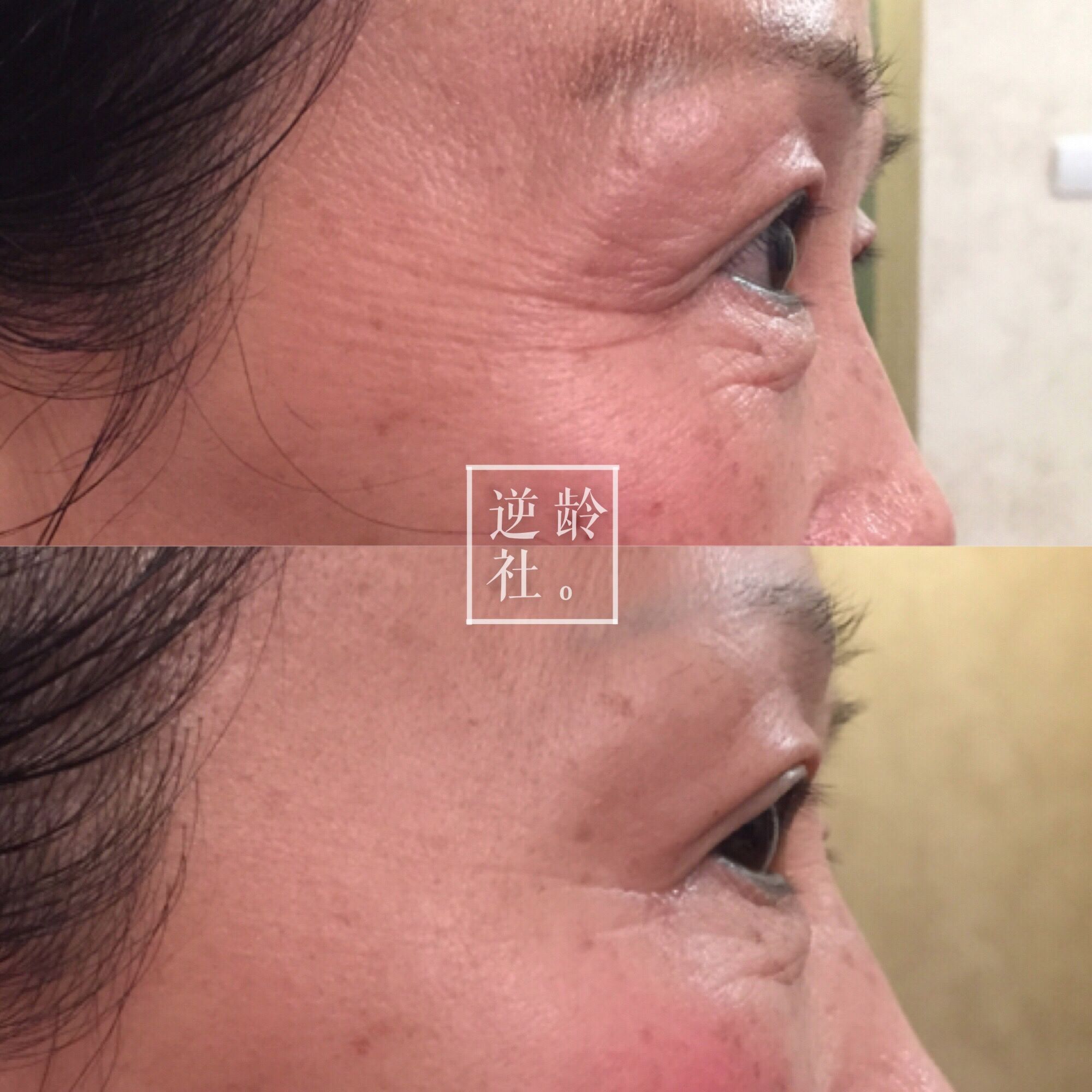 逆龄精雕好还是超声刀好,35岁做超声刀效果好吗