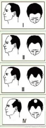 有没有好方法治地中海脱发,地中海脱发戴什么假发