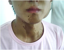 千奇百怪的胎记,各类胎记