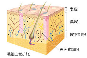 千奇百怪的胎记,各类胎记