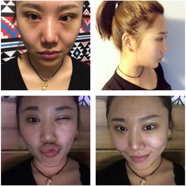 全切双眼皮会不会显老,全切双眼皮显老可以修复年轻吗