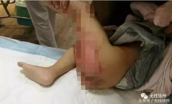 3岁女童被烧成火人!不到半个月徐州一医院已经接了4例!
