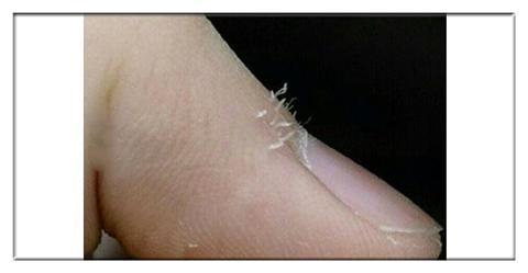 女子拔倒刺感染致整个指甲被拔掉,拔了根倒刺为什么会截肢