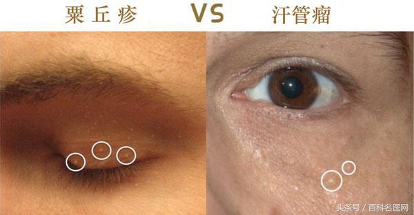 眼霜去脂肪粒哪个眼霜好,眼霜推荐不长油脂粒吗