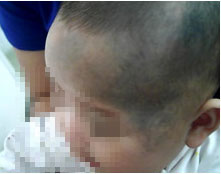 千奇百怪的胎记,各类胎记