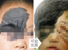 千奇百怪的胎记,各类胎记