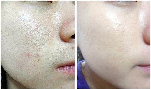 毛孔粗大不卡粉底妆技巧,痘印还有粗大毛孔怎么上妆不卡粉