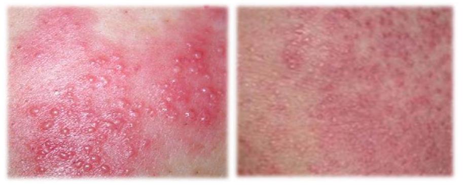 肿瘤不良反应怎么治疗最好,放个大招完整版教学