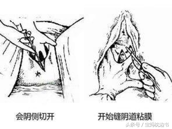 顺产避免侧切和撕裂的方法,一胎顺产侧切二胎怎么避免侧切