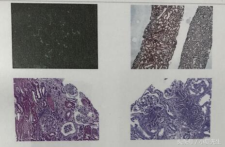 局灶节段性肾小球硬化的治疗方法,肾穿刺出来全部硬化了