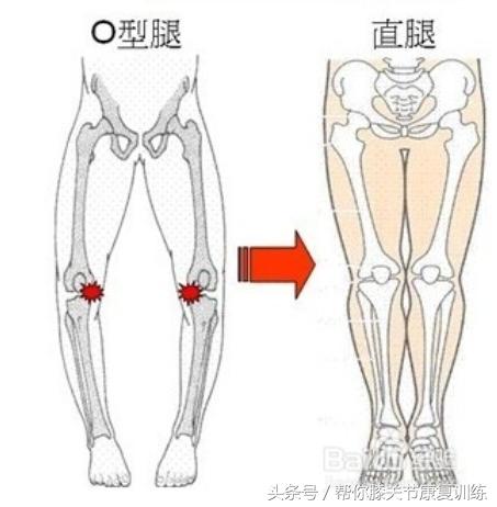 怎么纠正宝宝o型腿,o型腿矫正神器哪种好