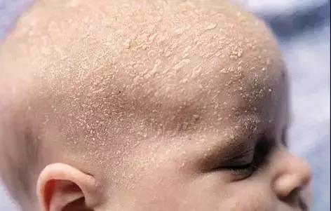 湿疹感染了严重怎么办,湿疹感染的最佳治疗方法婴儿