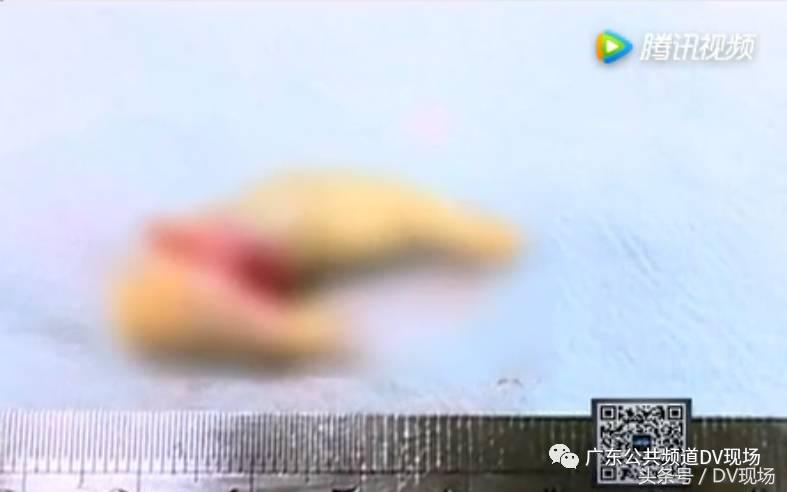 颈动脉堵塞会引起呼吸困难吗,颈动脉血管堵塞60%严重吗