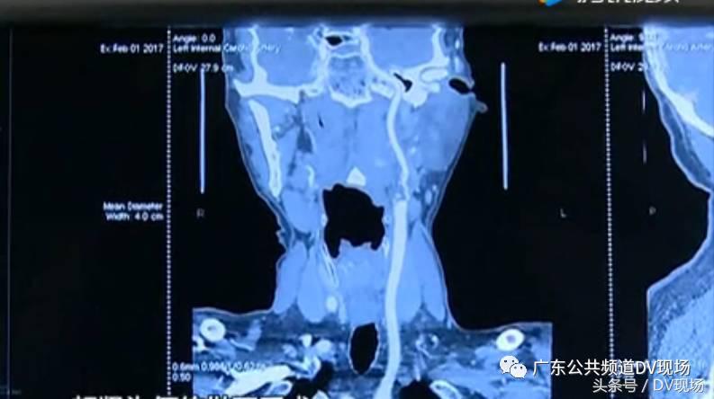 颈动脉堵塞会引起呼吸困难吗,颈动脉血管堵塞60%严重吗