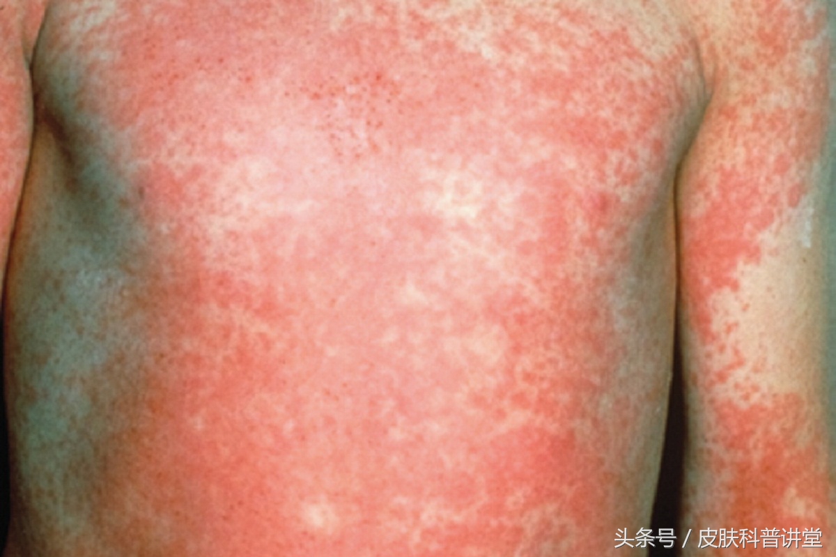 如何辨别儿童猩红热,儿童猩红热的症状与表现