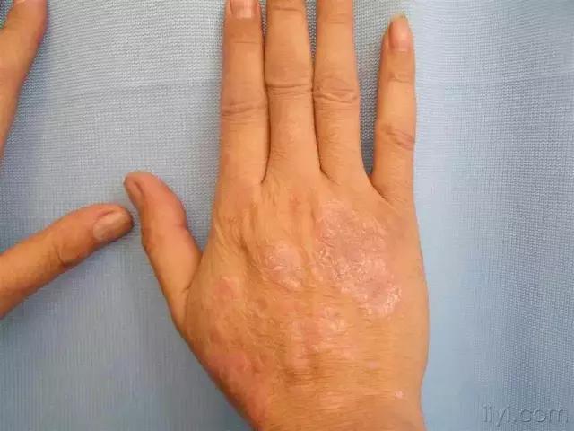 得了银屑病为什么会反复难根治呢,得了银屑病3种药膏请收藏