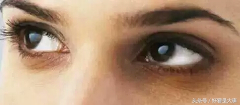 黑眼圈真的就没办法了吗,黑眼圈真的没办法了吗