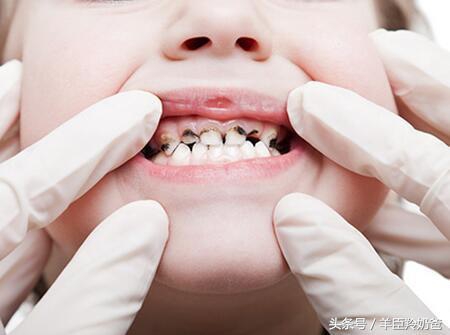 六龄齿坏了后边的牙齿能往前移吗,孩子的六龄齿会不会换