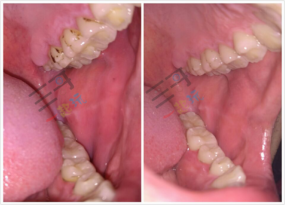 亲身体验清洁效果,洗牙体验全视频