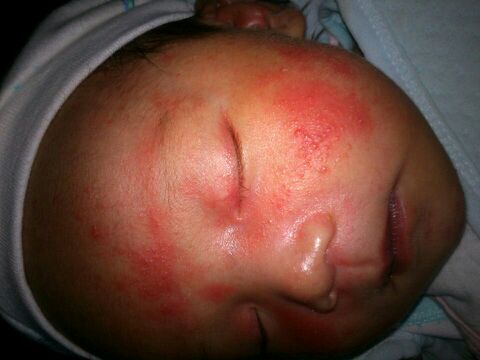 为什么宝宝湿疹好了后皮肤变黑了,宝宝湿疹好后皮肤变黑怎么回事