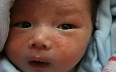 为什么宝宝湿疹好了后皮肤变黑了,宝宝湿疹好后皮肤变黑怎么回事