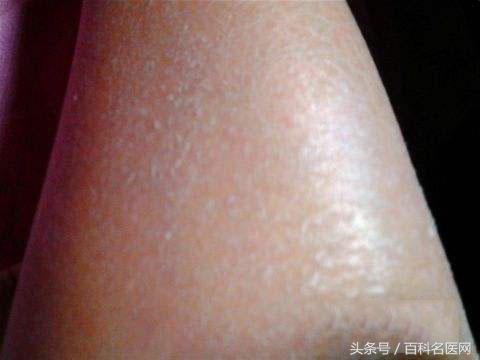 湿气会引起皮肤干燥粗糙吗,体内湿气重皮肤却很干中医辨证
