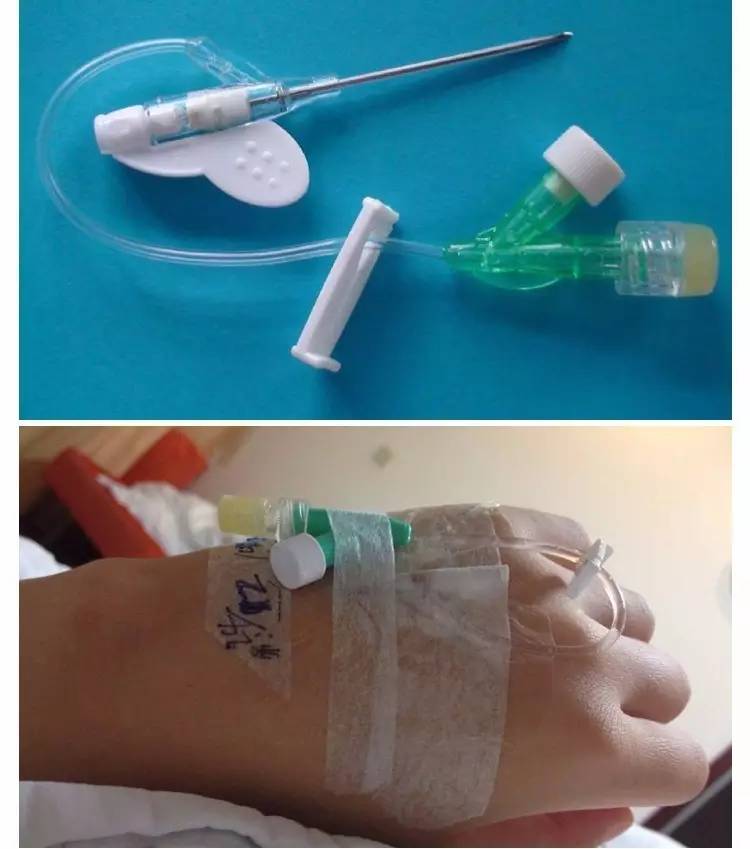 宝宝输液用留置针好还是钢针好,输液扎针时用软针管好吗