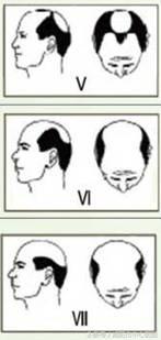 有没有好方法治地中海脱发,地中海脱发戴什么假发
