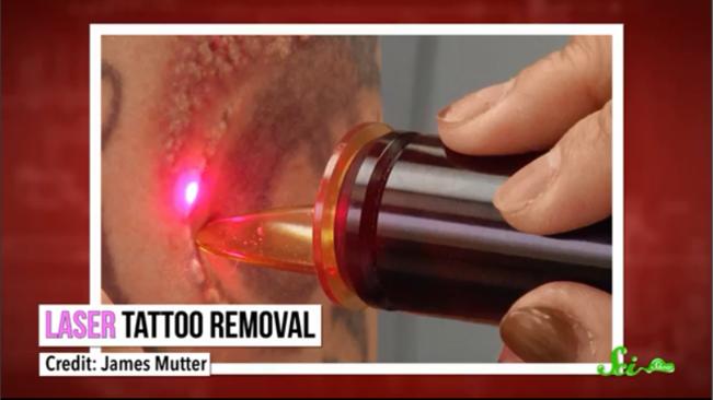 怎样可以去除纹身,怎么去除纹身