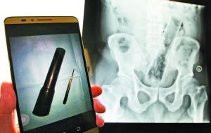 杭州男子肛门被塞20公分长振动棒称年会被恶搞(图