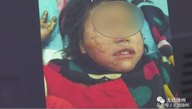 3岁女童被烧成火人!不到半个月徐州一医院已经接了4例!