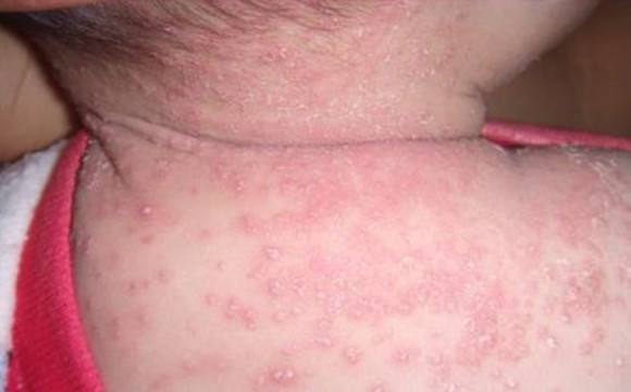 治新生儿湿疹的药,新生儿头上有湿疹