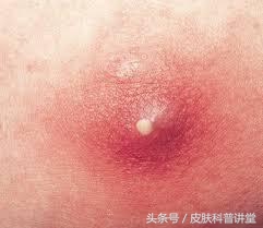 疖病科普文章,疖与疖病