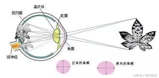 斜轴散光近视手术原则,儿童散光配镜原则及预防