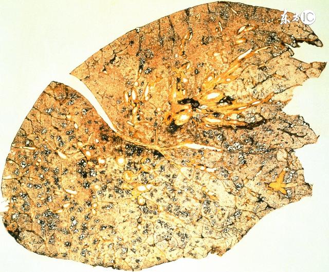 引起肺癌的三大主要原因,诱发肺癌的原因