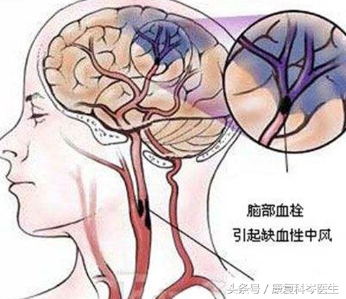 脑血栓治愈后还会复发吗,脑血栓血管堵塞还能再通吗