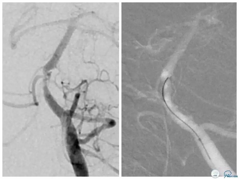 天坛医院基底动脉,天坛医院脑血管支架费用高吗