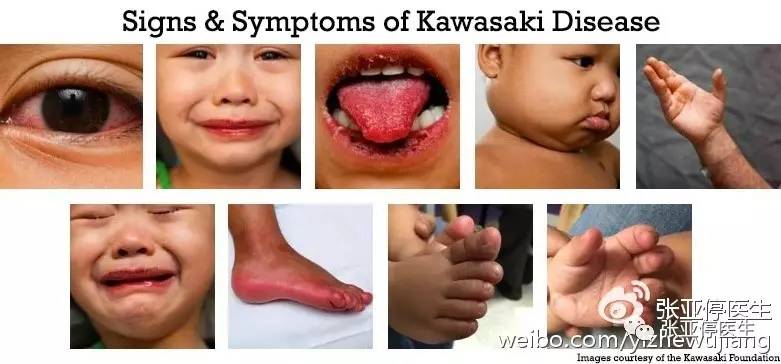 一岁宝宝会得川崎病了吗,9个月宝宝得了川崎病有影响吗