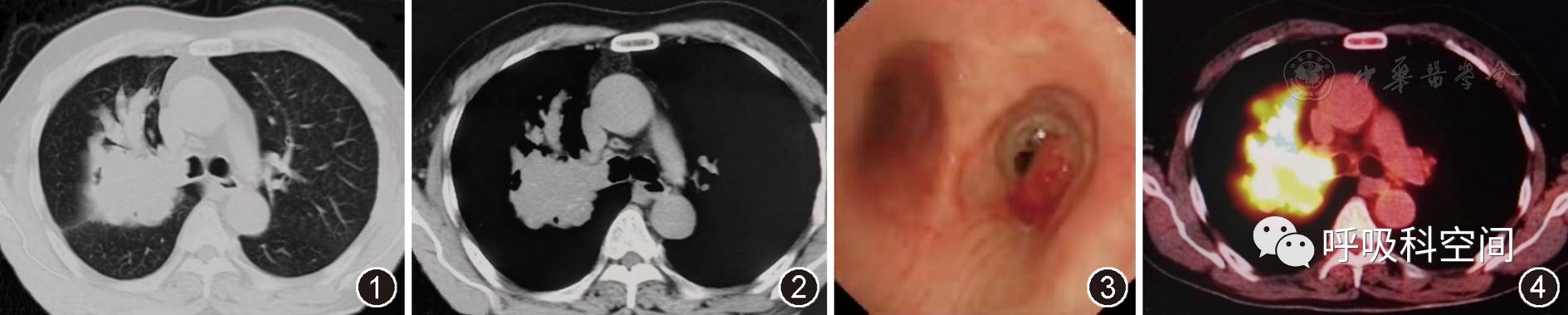 「读片」右上肺指套征