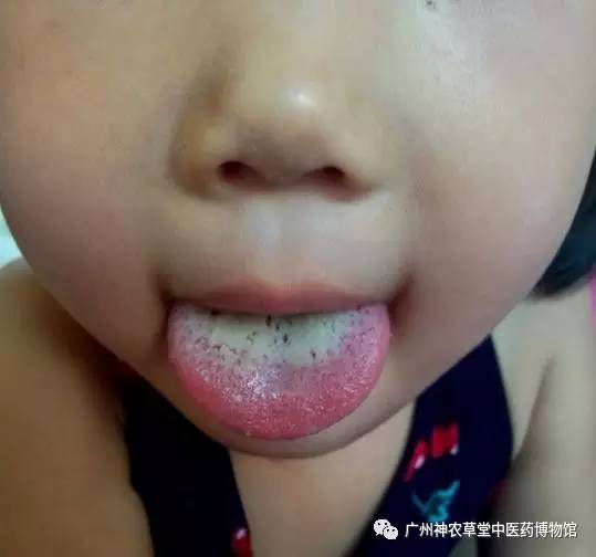 舌头上的脏东西需要每天清洁吗,舌头发白是口腔粘膜损坏吗