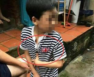 柳州一5岁孩子被小伙伴咬伤胸口,家长要求打狂犬疫苗!