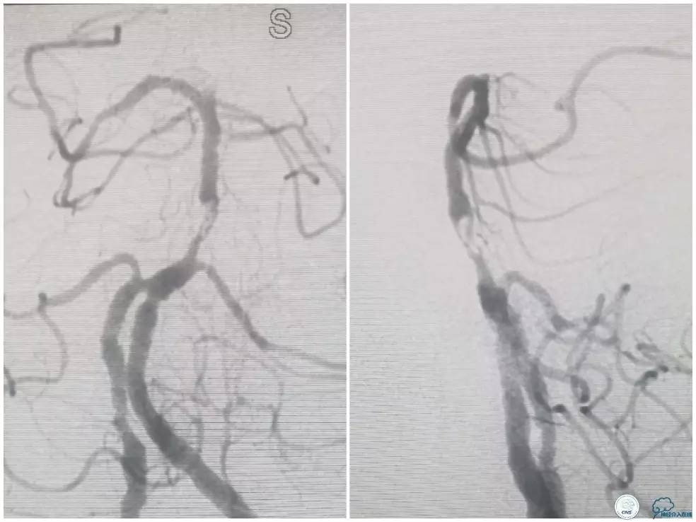 天坛医院基底动脉,天坛医院脑血管支架费用高吗