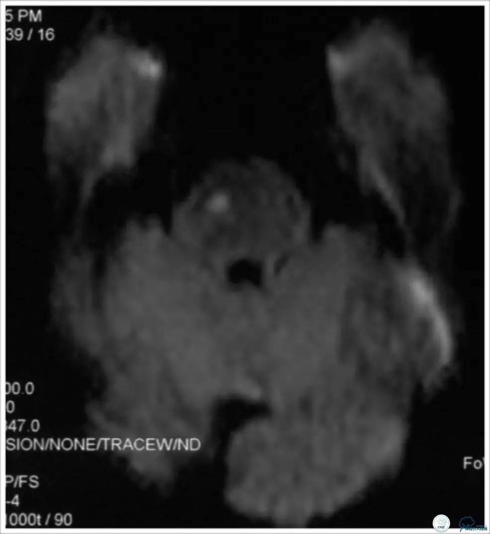天坛医院基底动脉,天坛医院脑血管支架费用高吗